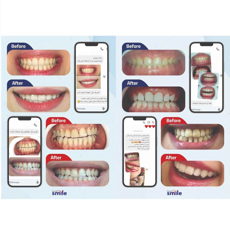 کیت بلیچینگ سفید کننده دندان خانگی دنتیلایت مدل Smile مجموعه 5 عددی
